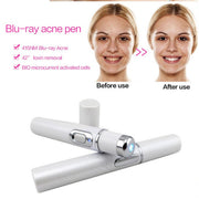 Blue Light Therapy Acne Laser Pen Soft Scar Wrinkle Removal Treatment Device Skin Care Beauty Equipment - TRADINGSUSAHave a logo 4pcsBlue Light Therapy Acne Laser Pen Soft Scar Wrinkle Removal Treatment Device Skin Care Beauty EquipmentTRADINGSUSA